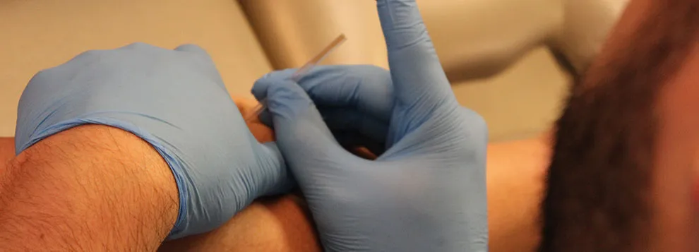 Gloved hands of an Iron City therapist placing a dry needling needle near a patient’s shoulder
